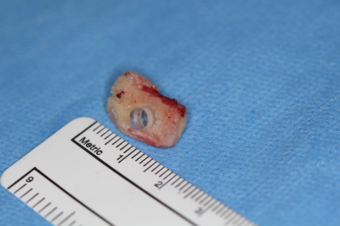 tooth-in-eye-surgery-1 A bloody tooth with a hole drilled into it next to a ruler showing it's about 1.5 centimetres long