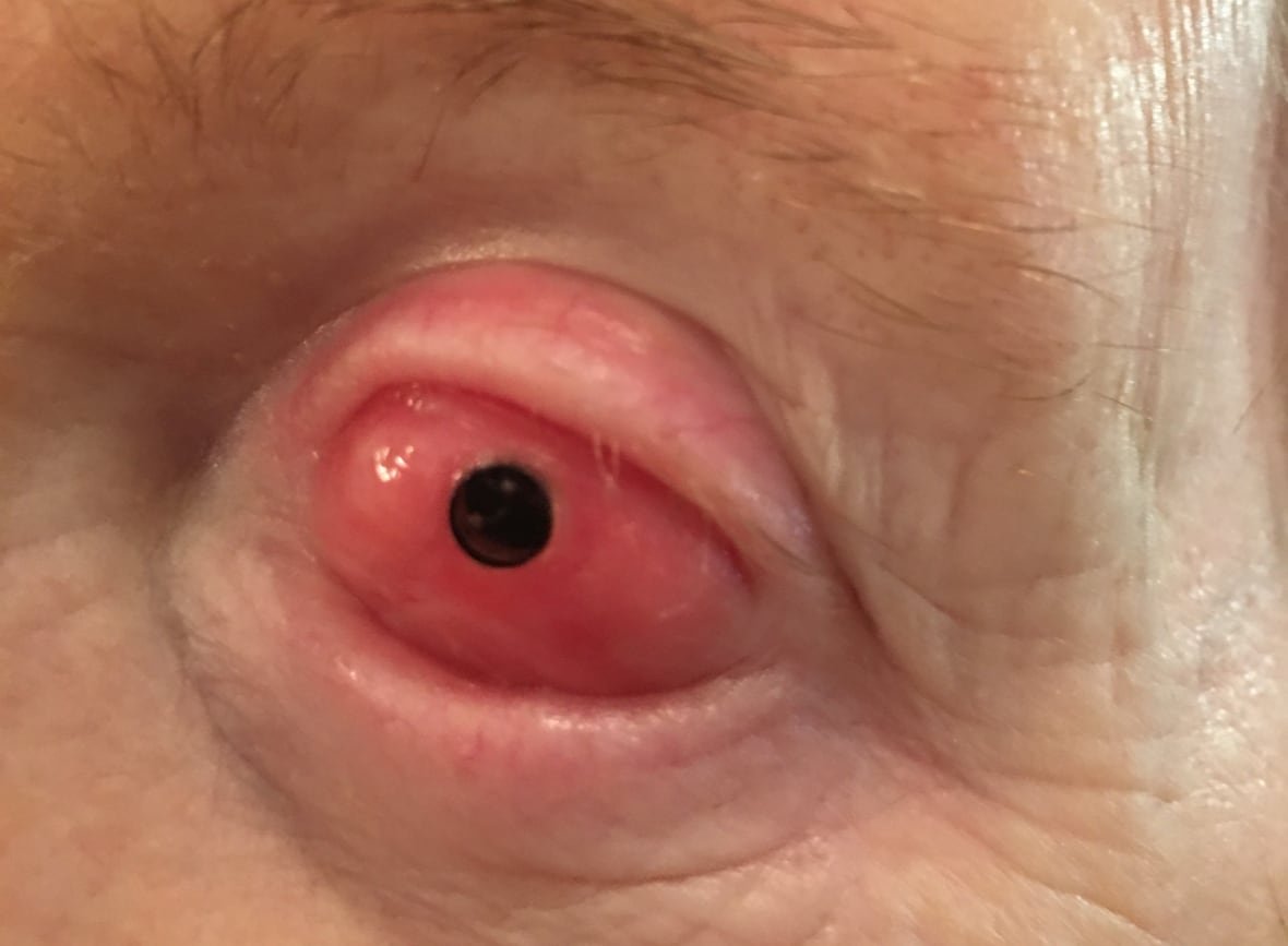 tooth-in-eye-surgery-2 Close-up of a person's eyeball. It's pink all over with a small black circle in the centre.